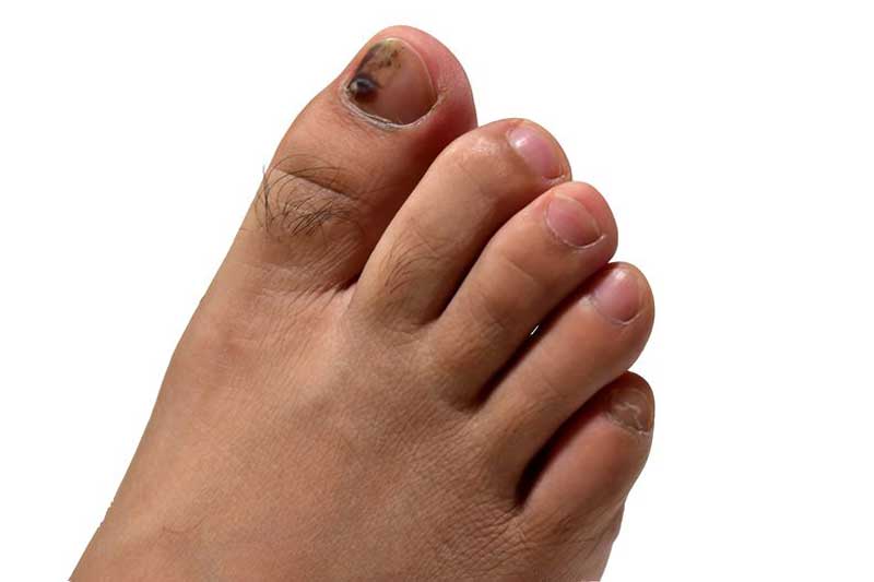 pedicure blauwe nagel voet